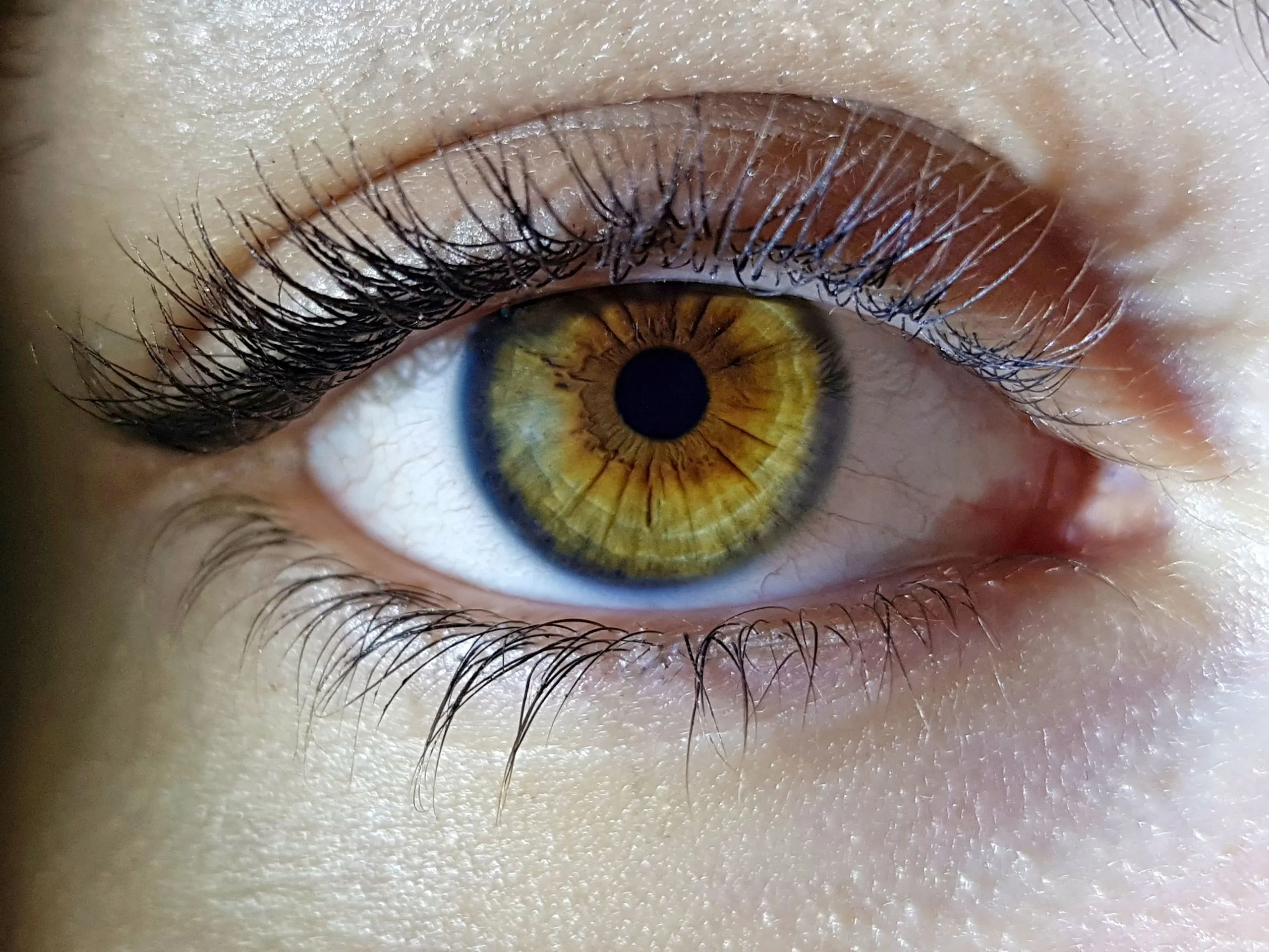 Diabetic retinopathy can cause blindness