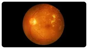 types of Macular Degeneration