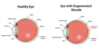 symptoms of Macular Degeneration