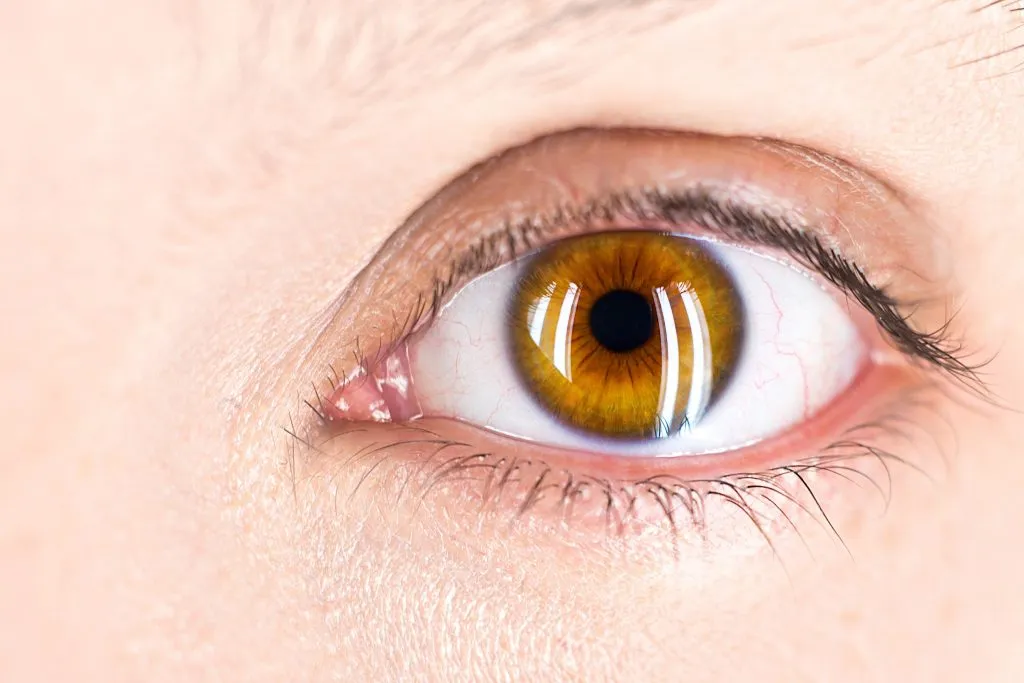 Retinitis Pigmentosa
