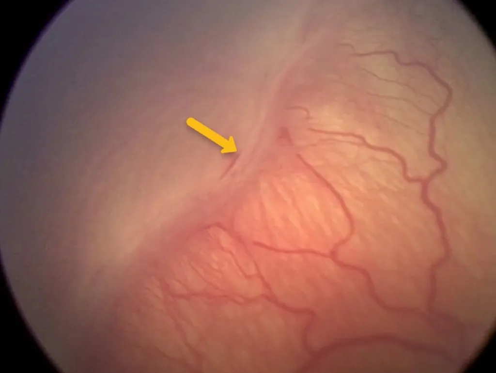 Retinopathy of Prematurity Stage III