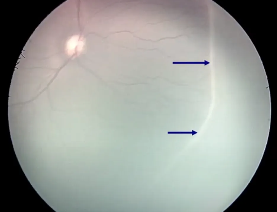 Retinopathy of Prematurity Stage I