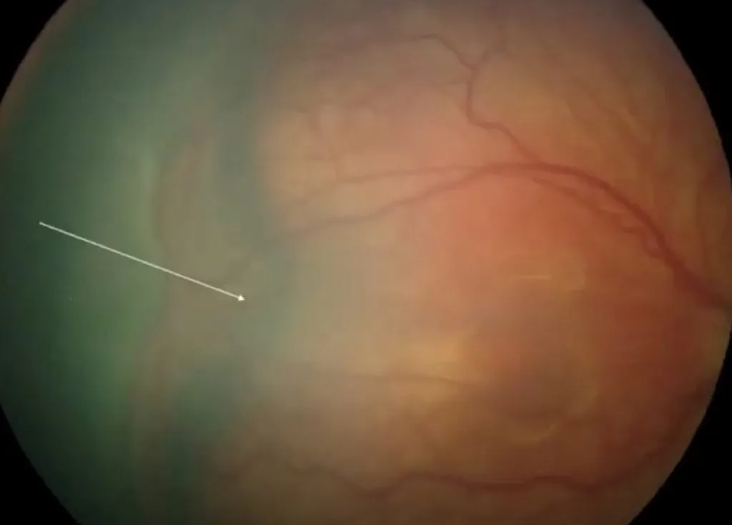 Retinopathy of Prematurity Stage IV