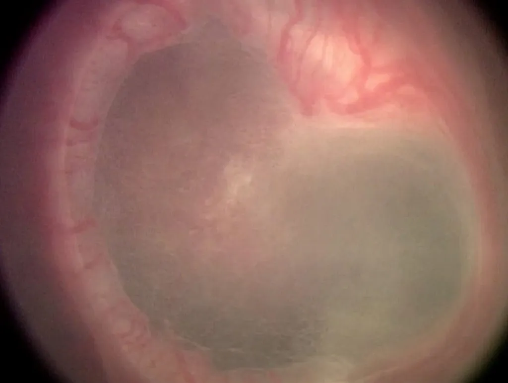 Retinopathy of Prematurity Stage V