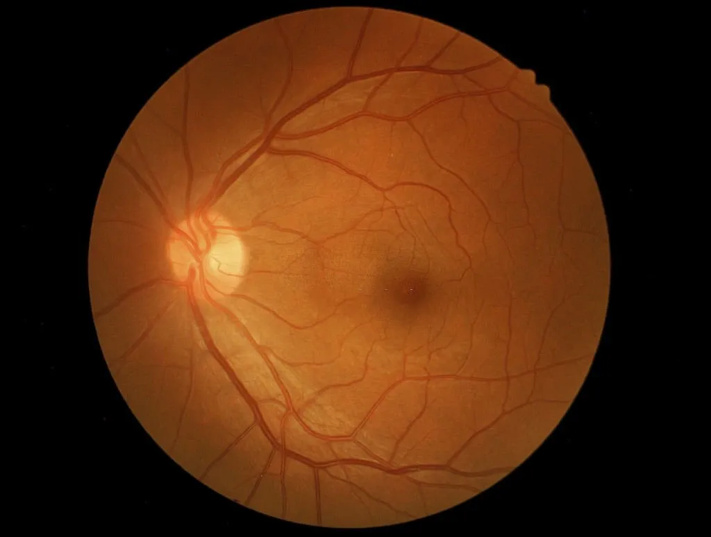Stargardt’s Disease Symptoms, Causes, Diagnosis, and Treatment