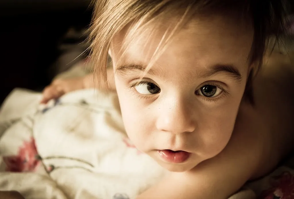 Causes of strabismus