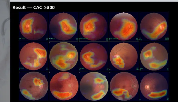 detect Diabetic Retinopathy disease