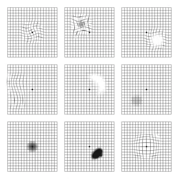 Amsler grid for macular degeneration