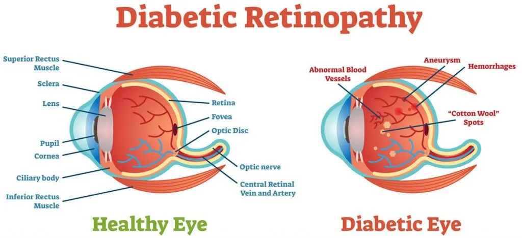 Diabetic Retinopathy causes