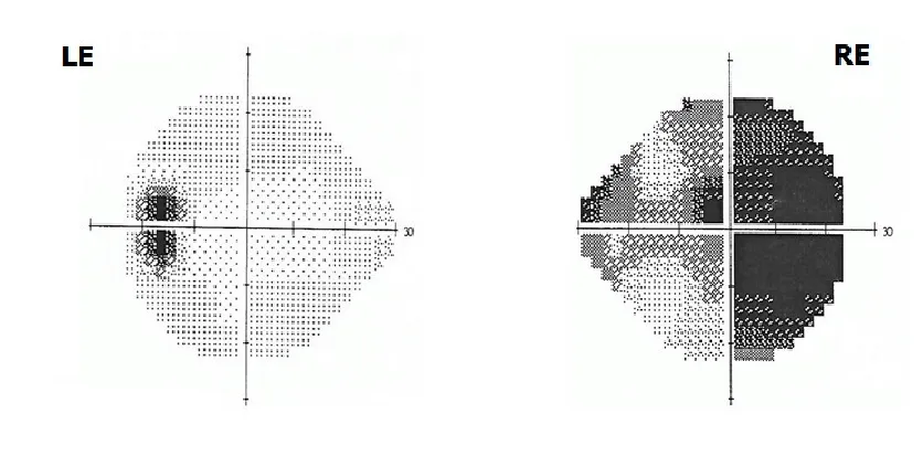 Visual Field Testing