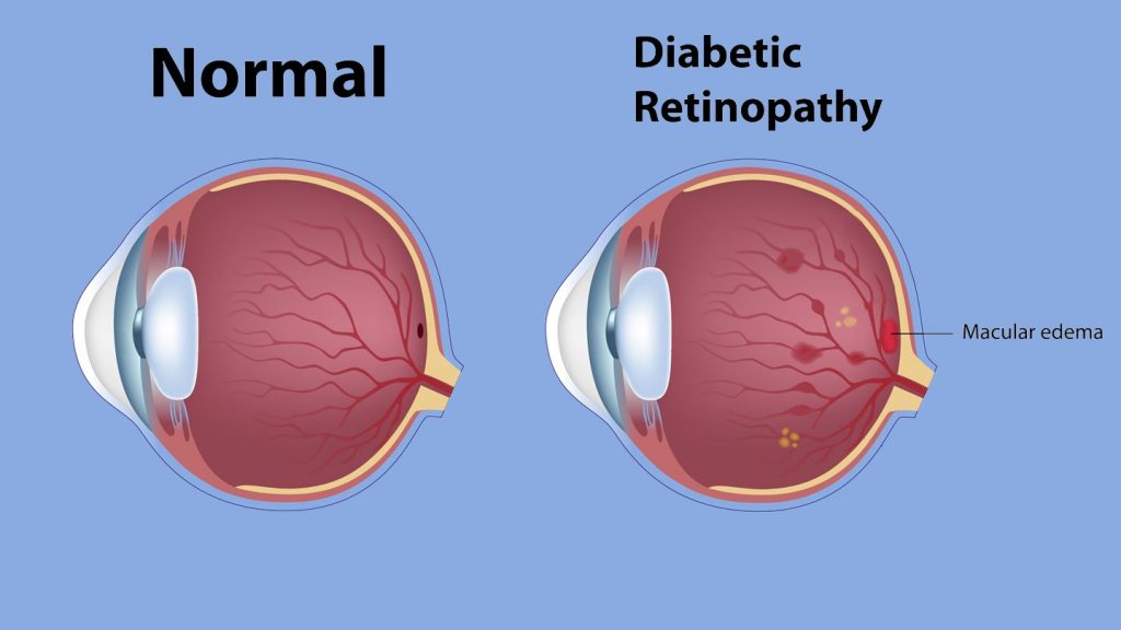 Diabetic Retinopathy Symptoms
