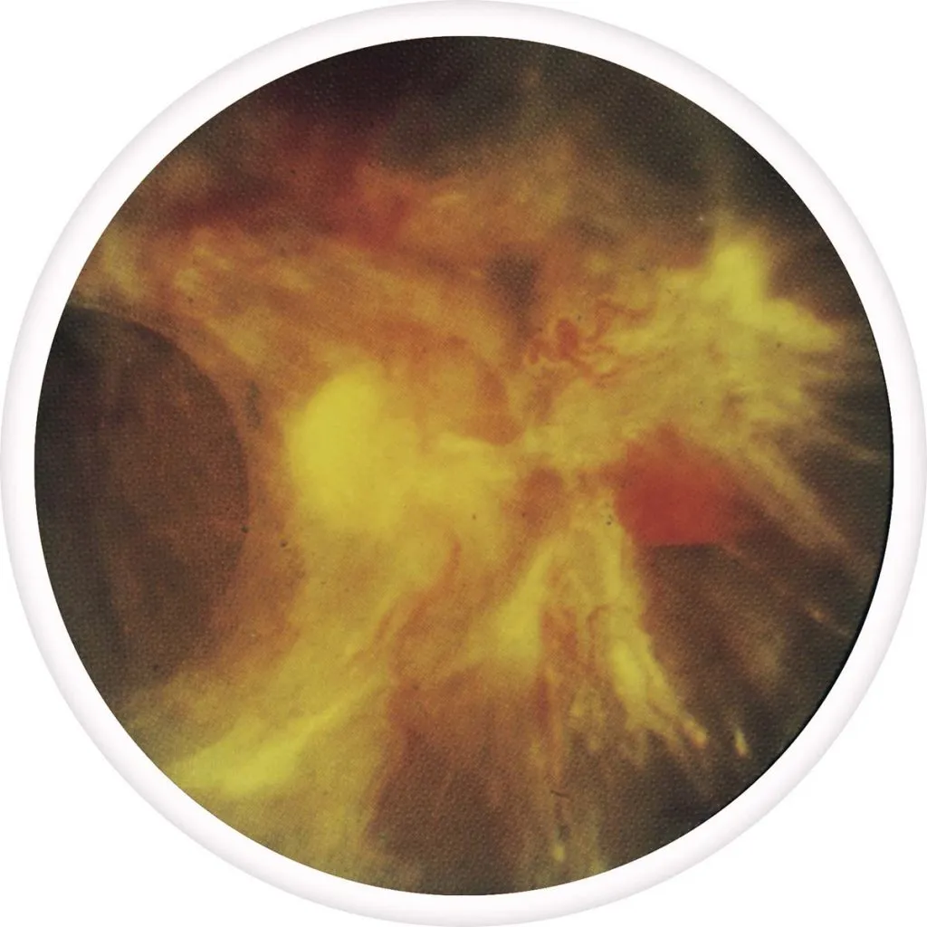 treat Diabetic Retinopathy