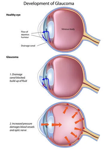 Glaucoma Symptoms