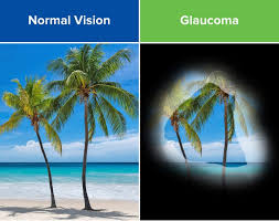 detect Glaucoma disease