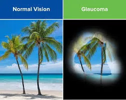 detect Glaucoma disease