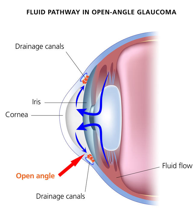 types of Glaucoma