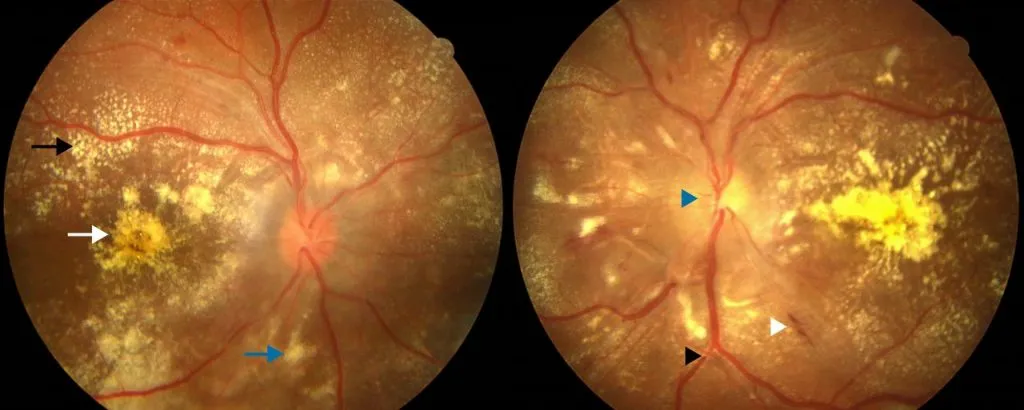 Diabetic Retinopathy an emergency