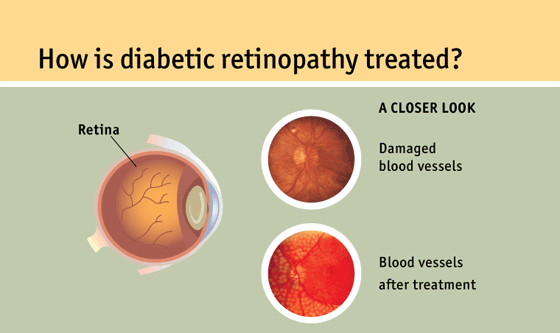 treatments for Diabetic Retinopathy