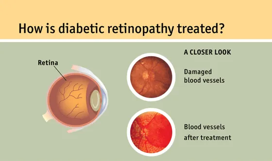 treatments for Diabetic Retinopathy