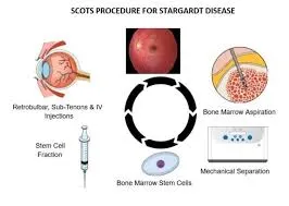 treatments are available for Stargardts