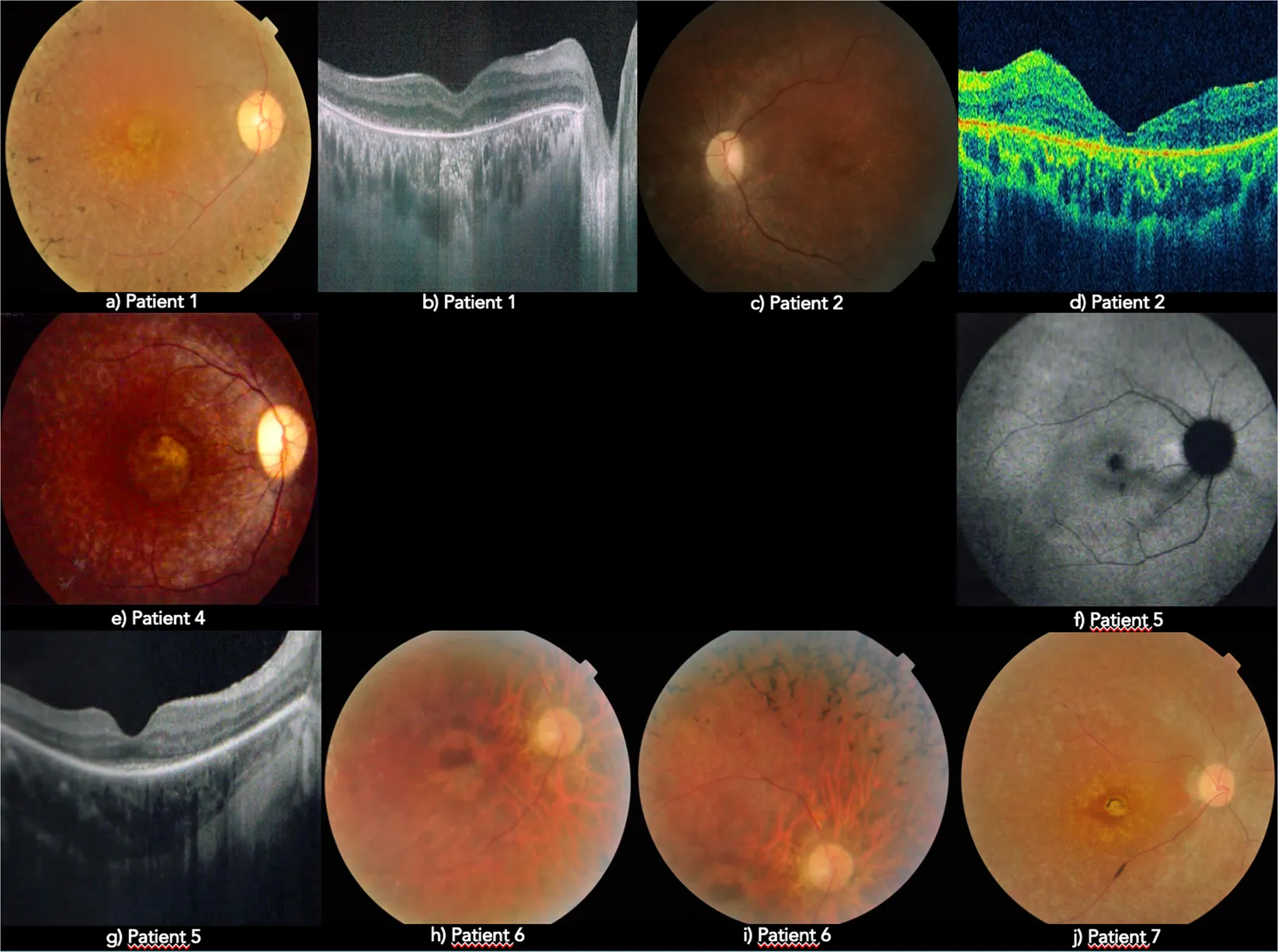 types of Retinitis Pigmentosa