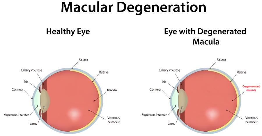 types of Macular Degeneration