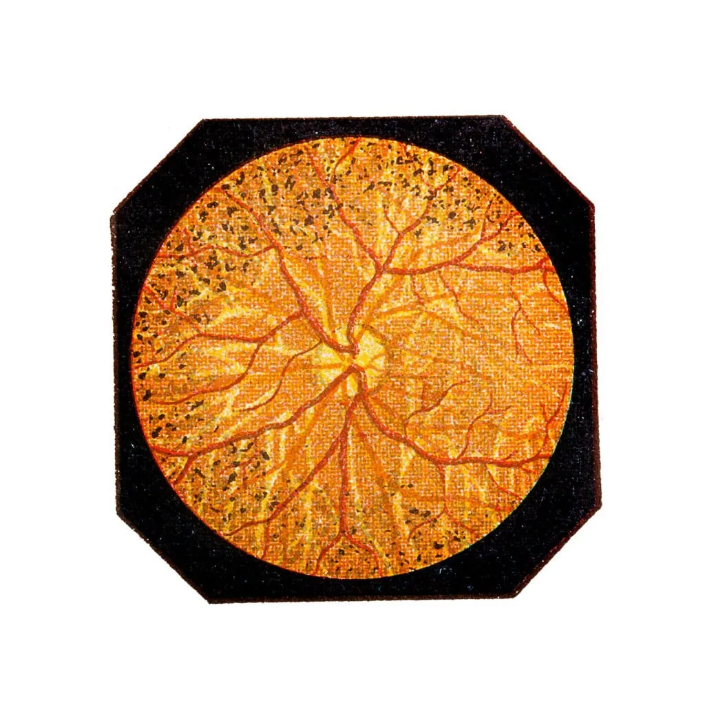 Is Retinitis Pigmentosa an emergency