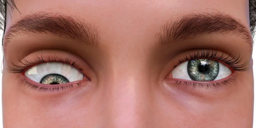 Vertical Strabismus Types