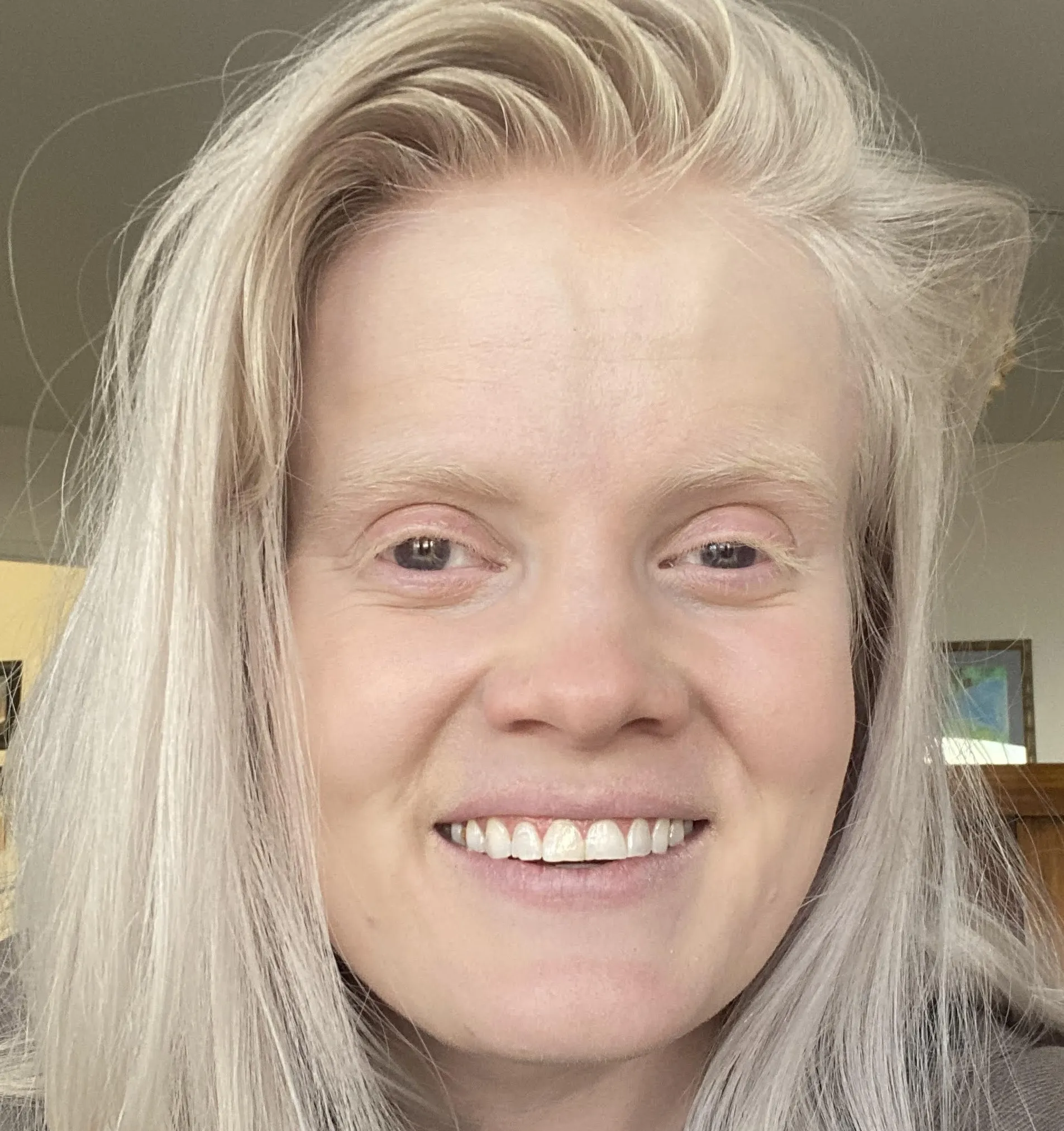 Start Macular Degeneration Treatment 31 Claire Hoffmann