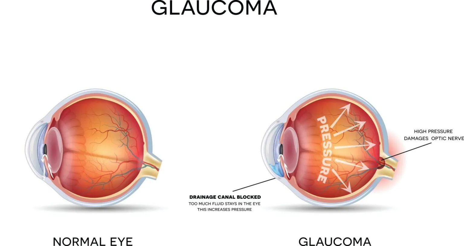 How long does it take to go blind from glaucoma?