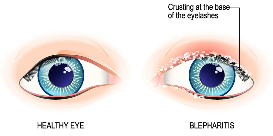 Blepharitis Bacteria