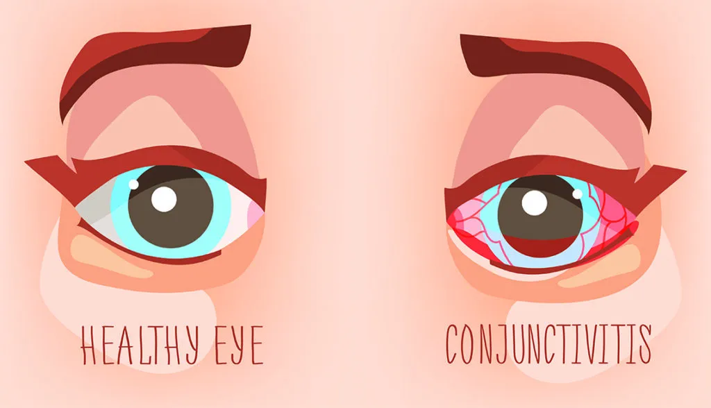 What You Need to Know About Conjunctivitis