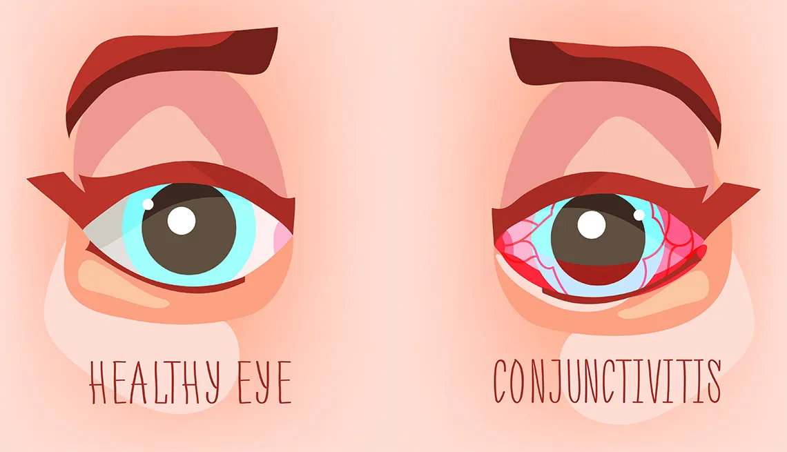 What You Need to Know About Conjunctivitis