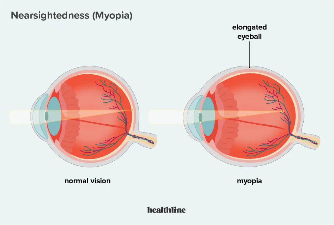 Myopic Macular Degeneration Who, What, Where and How?