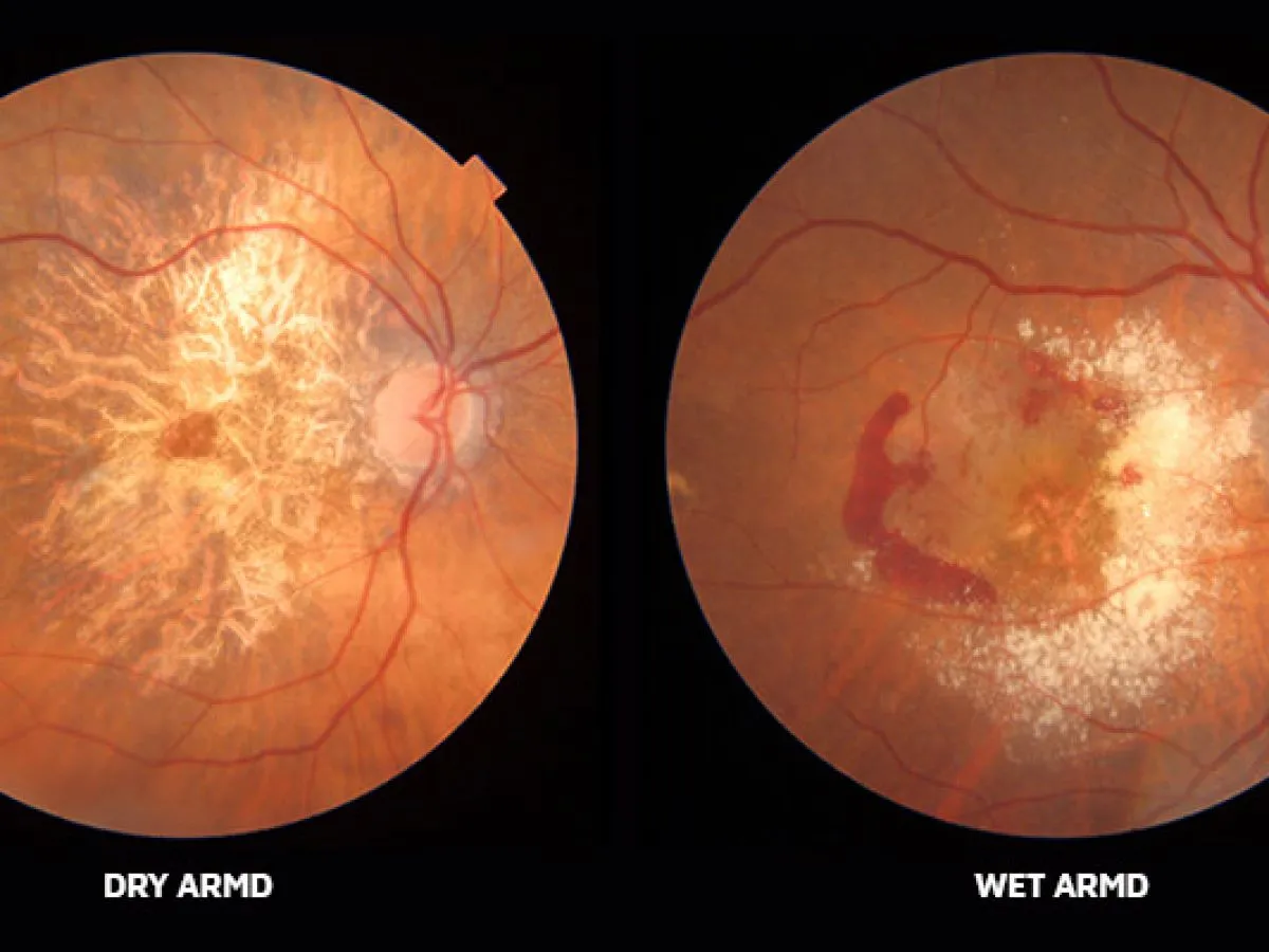 Promising New Treatments For Macular Degeneration Are On The Horizon