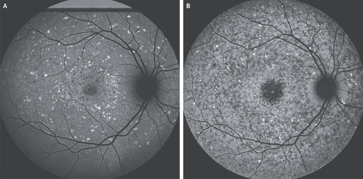 What Causes Macular Degeneration?