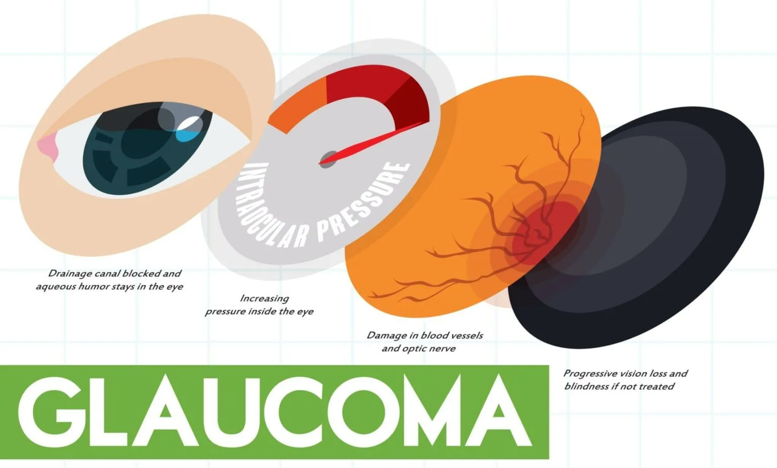 Understanding Glaucoma and Diabetes to Protect Your Vision