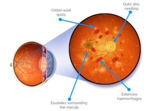 Hypertensive Retinopathy Stages