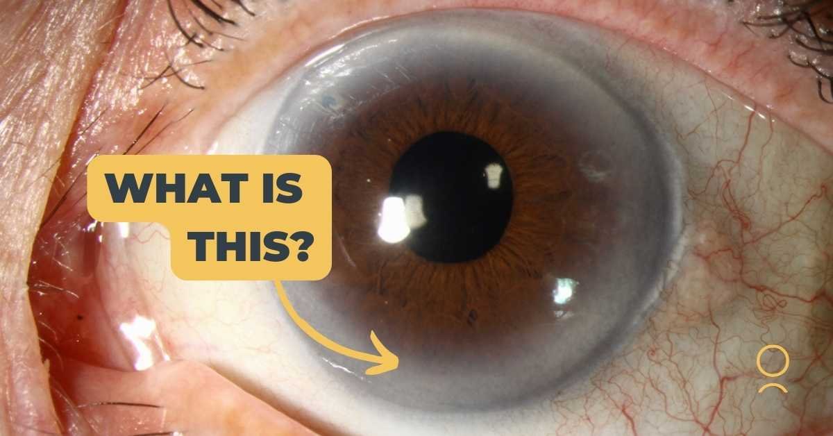 Corneal Arcus Images Signs Of High Cholesterol Corneal Arcus Images Signs Of High Cholesterol