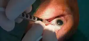 Low Vision Eye Disease 11 image 1