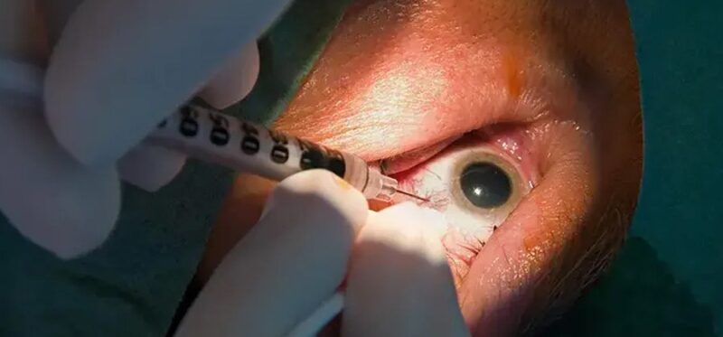 Avastin Eye Injection Explained: Cost & Effectiveness